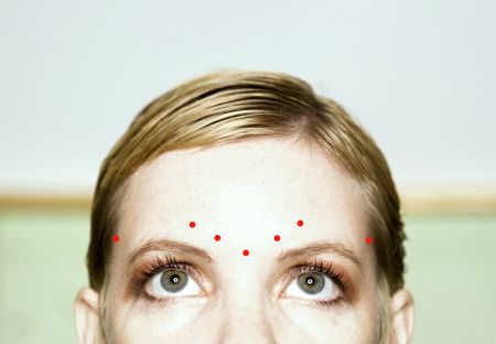 Typical Botox injection sites for migraine