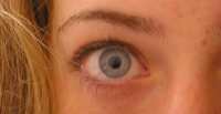 can migraine damage eyes